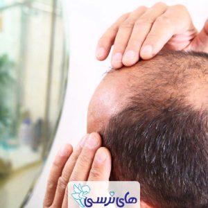 درمان ریزش مو خانگی