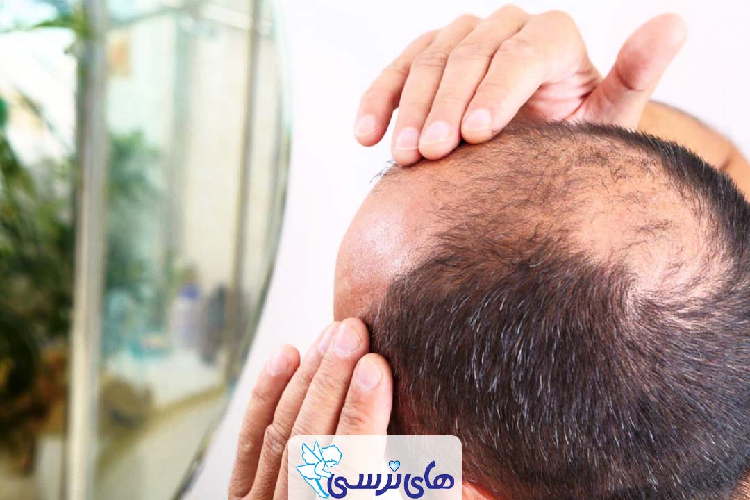 درمان ریزش مو خانگی