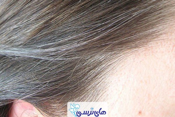 سفید شدن مو در جوانی